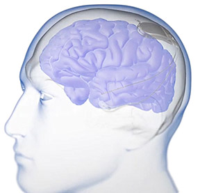 brain implant for 癫痫 treatment